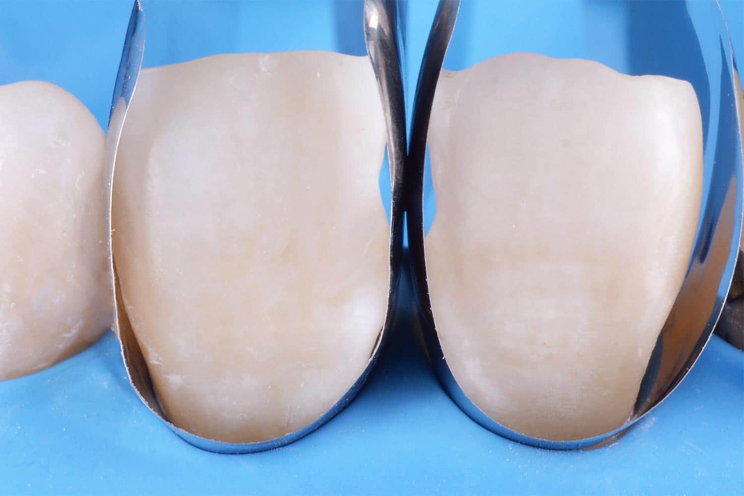 Unica anterior Introkit, polydentia - Image 2